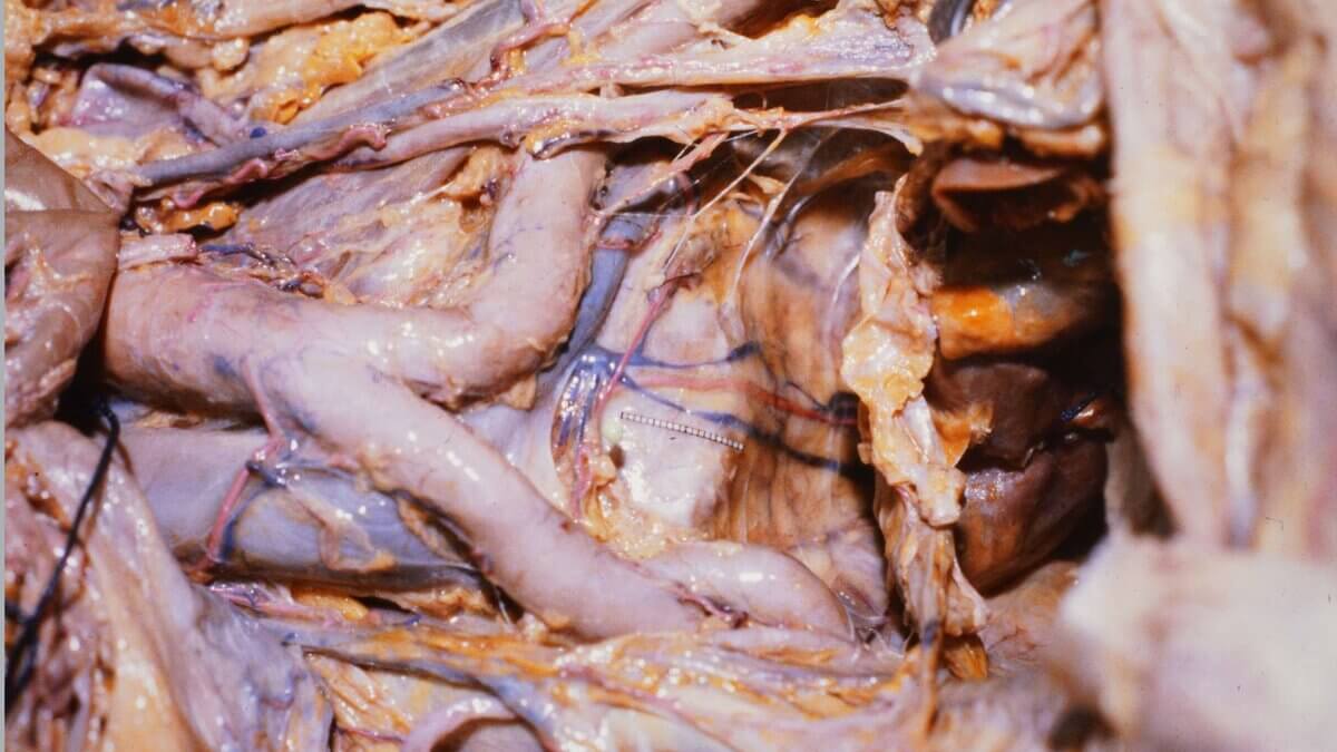 Aortenbifurkation