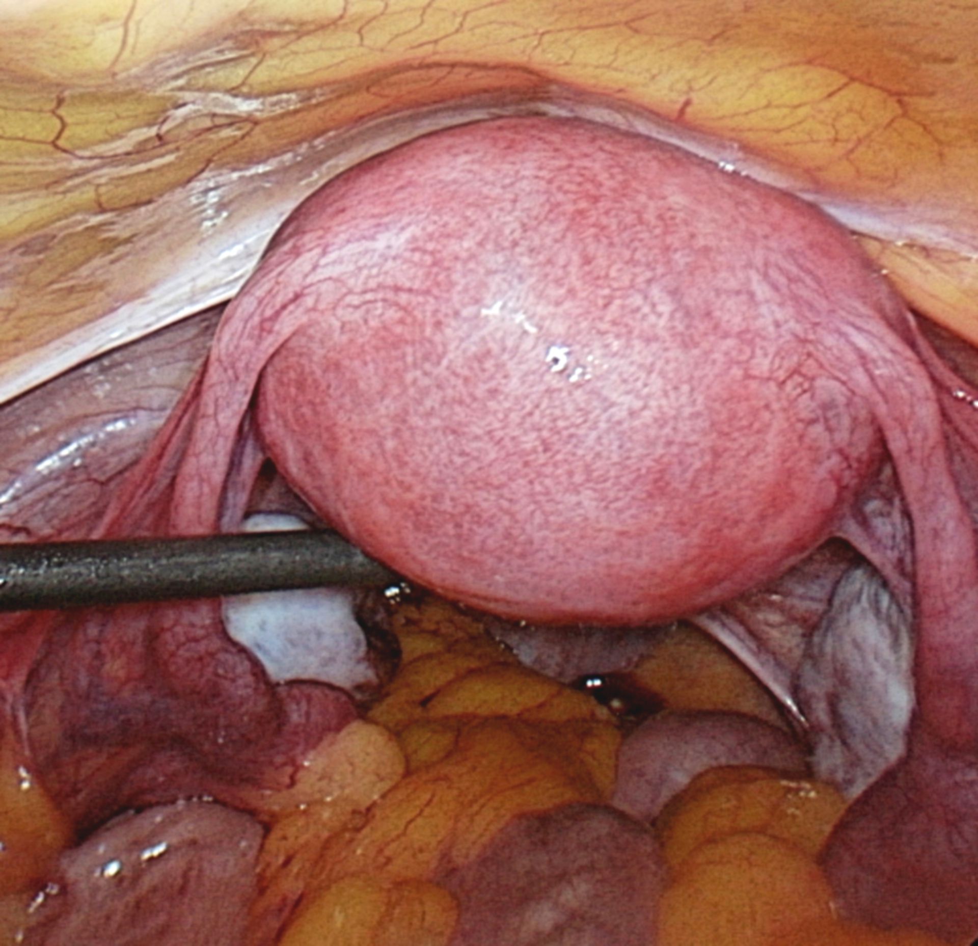 Gebärmutter mit anhängenden Eileitern und Eierstöcken