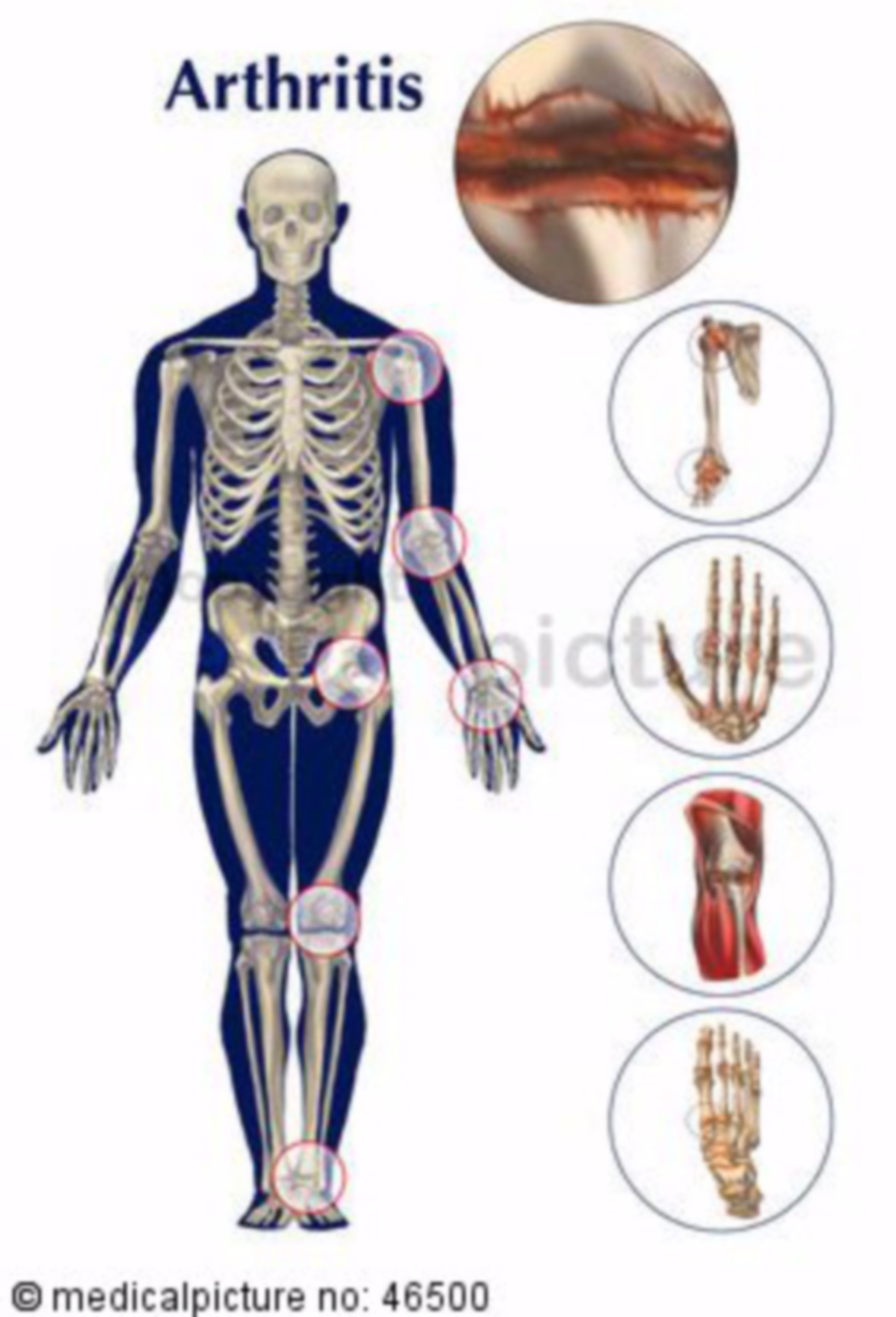  Menschliches Skelett mit Arthritis 
