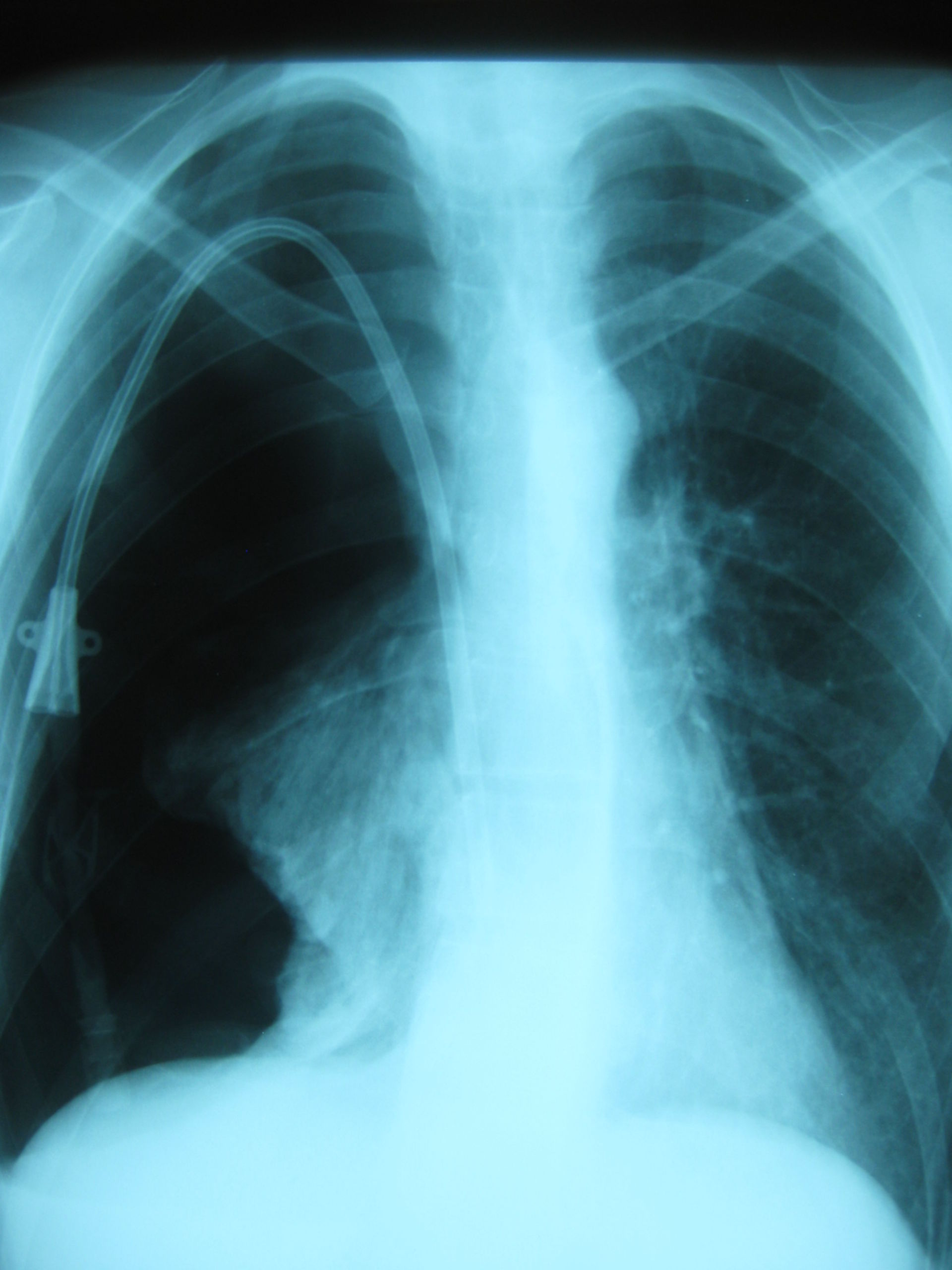 Pneumothorax on the right side