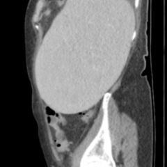Splenomegalie - DocCheck Flexikon