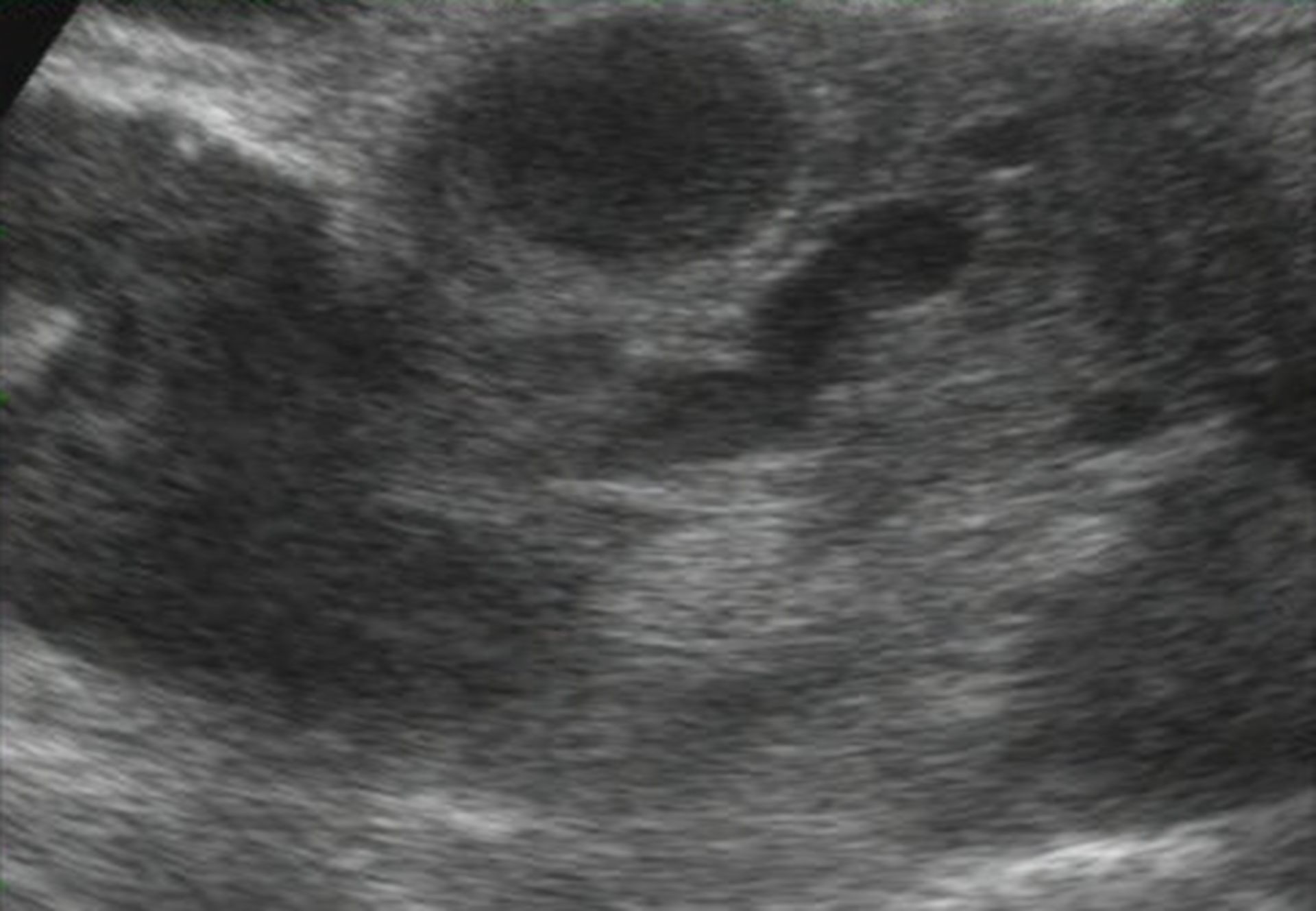 Carcinoma of the pancreas head