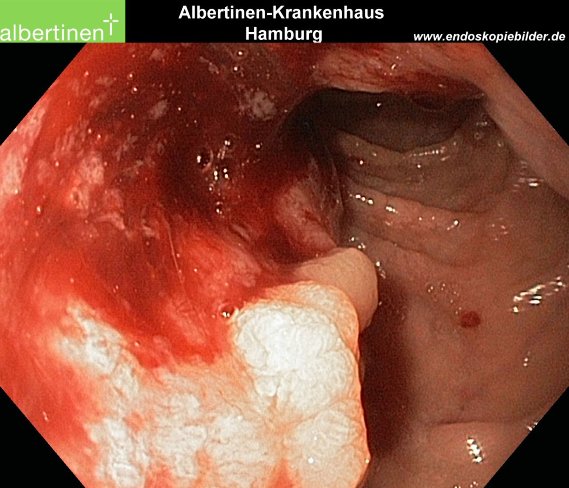 Duodenal-Carcinom Endo Pfeile