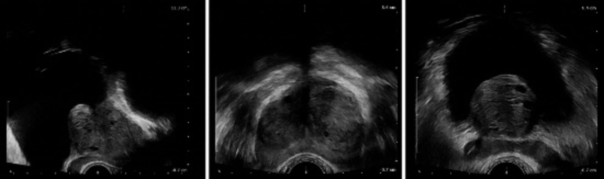Benign hyperplasia of the prostate with medial lobe in TRUS