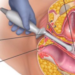 Klitoris beschneidung