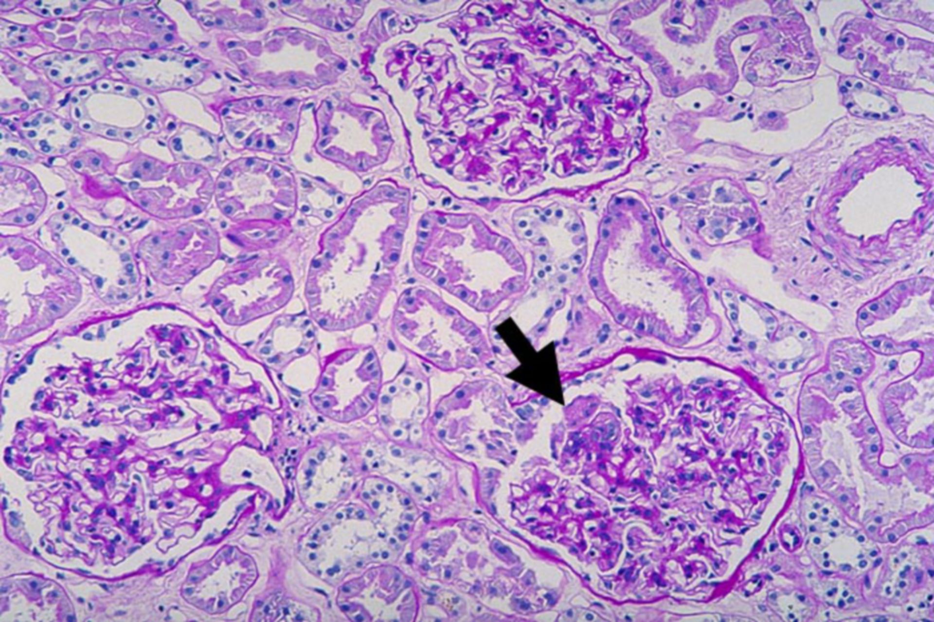 Purpura Schönlein Henoch: proliferative Glomerulonephritis (PAS-Färbung)
