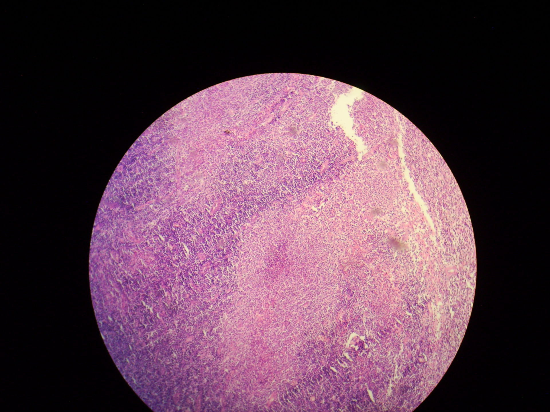 Lymphogranuloma inguinale