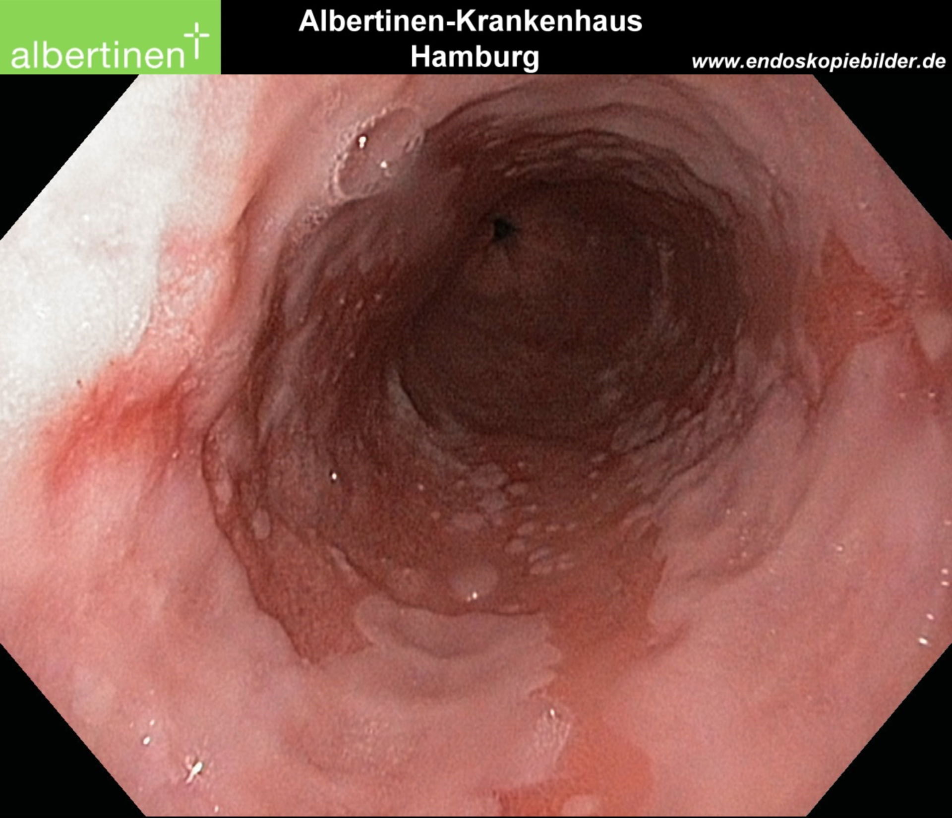 Segmento lungo esofago di Barrett - Endoscopia