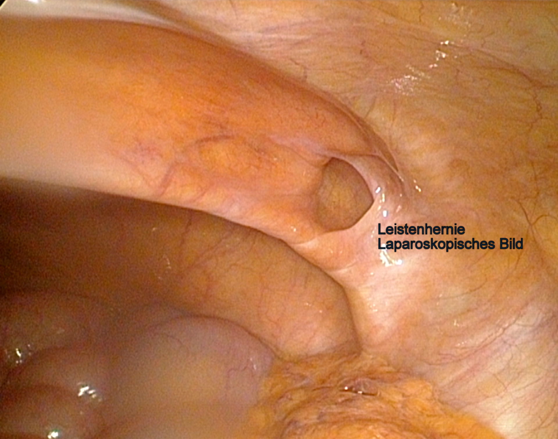 Hernia inguinal - imagen laparoscópica