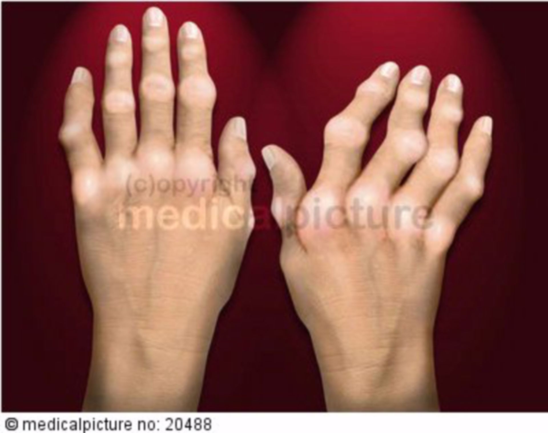  Deformierte Hände infolge rheumatoider Arthritis 
