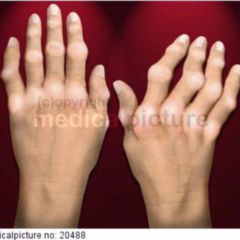 rheumatoide arthritis doccheck