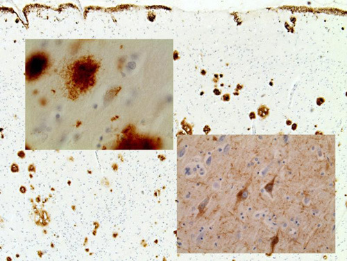 Antikörper gegen Beta-Amyloid machen die Plaques im Gehirngewebe durch die Färbung gut sichtbar (Bild oben links), Antikörper gegen abnormales tau-Protein zeigen dagegen typische Veränderung. © Dietmar Thal