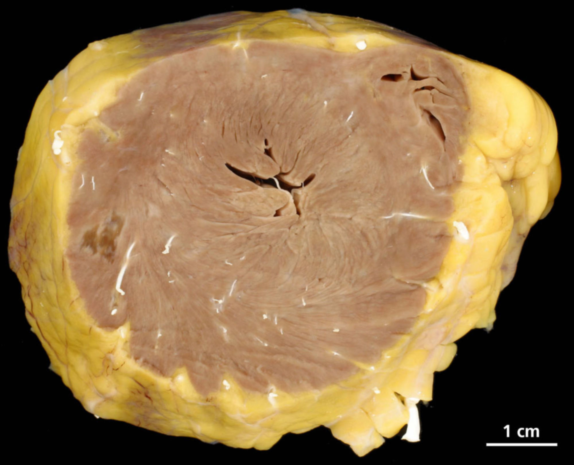 Myocardial hypertrophy, subacute necrosis