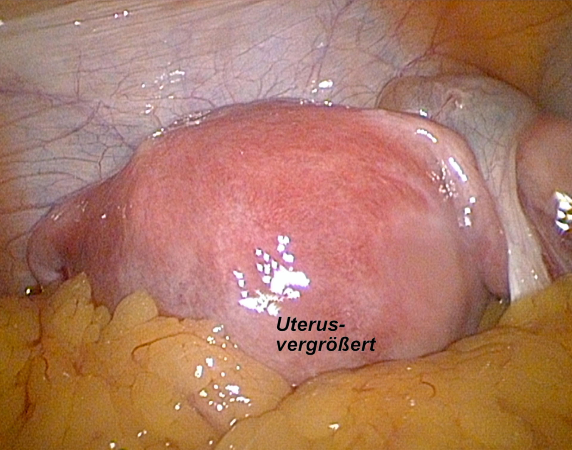 Laparoskopie - Uterus