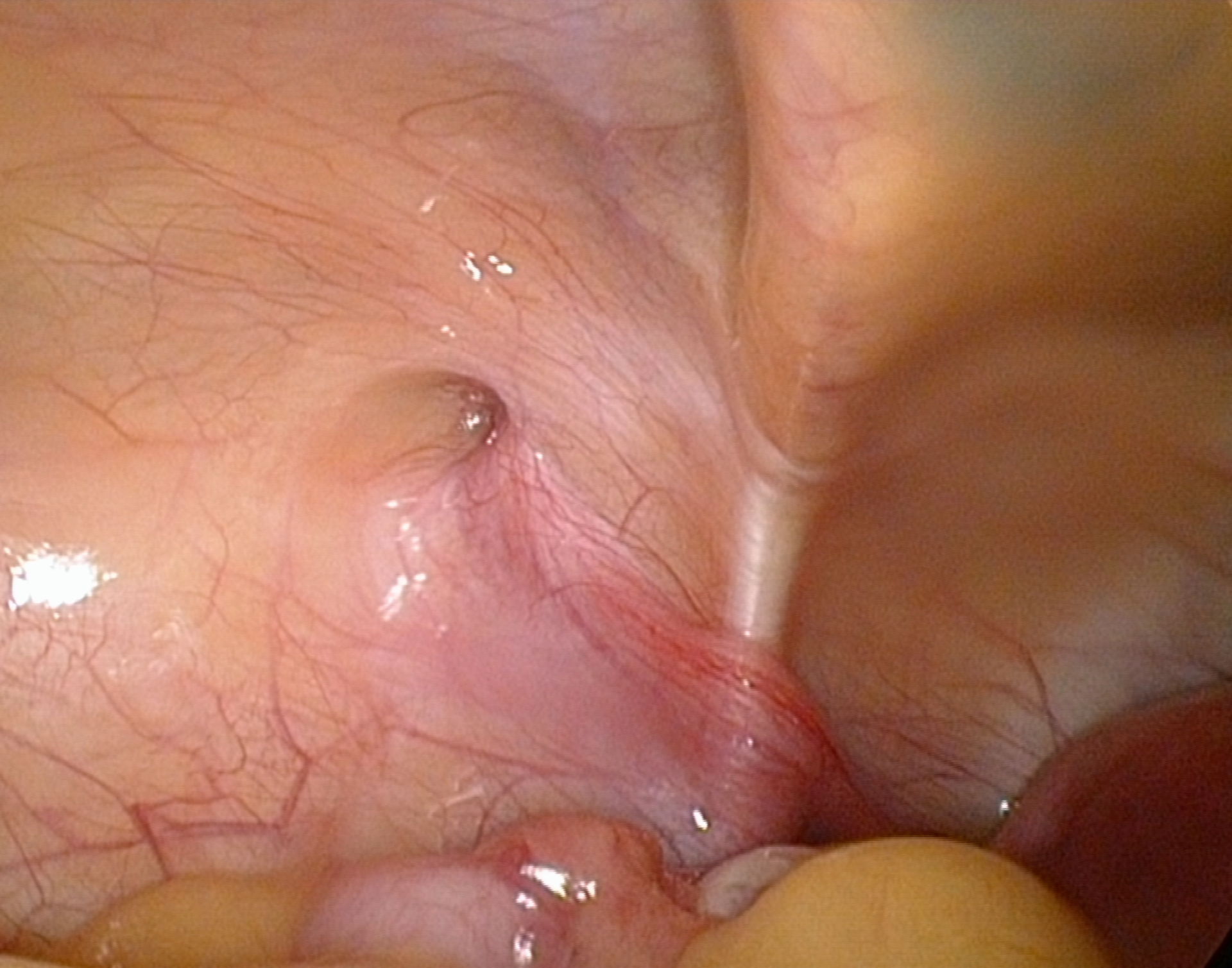 Small inguinal hernia, left side