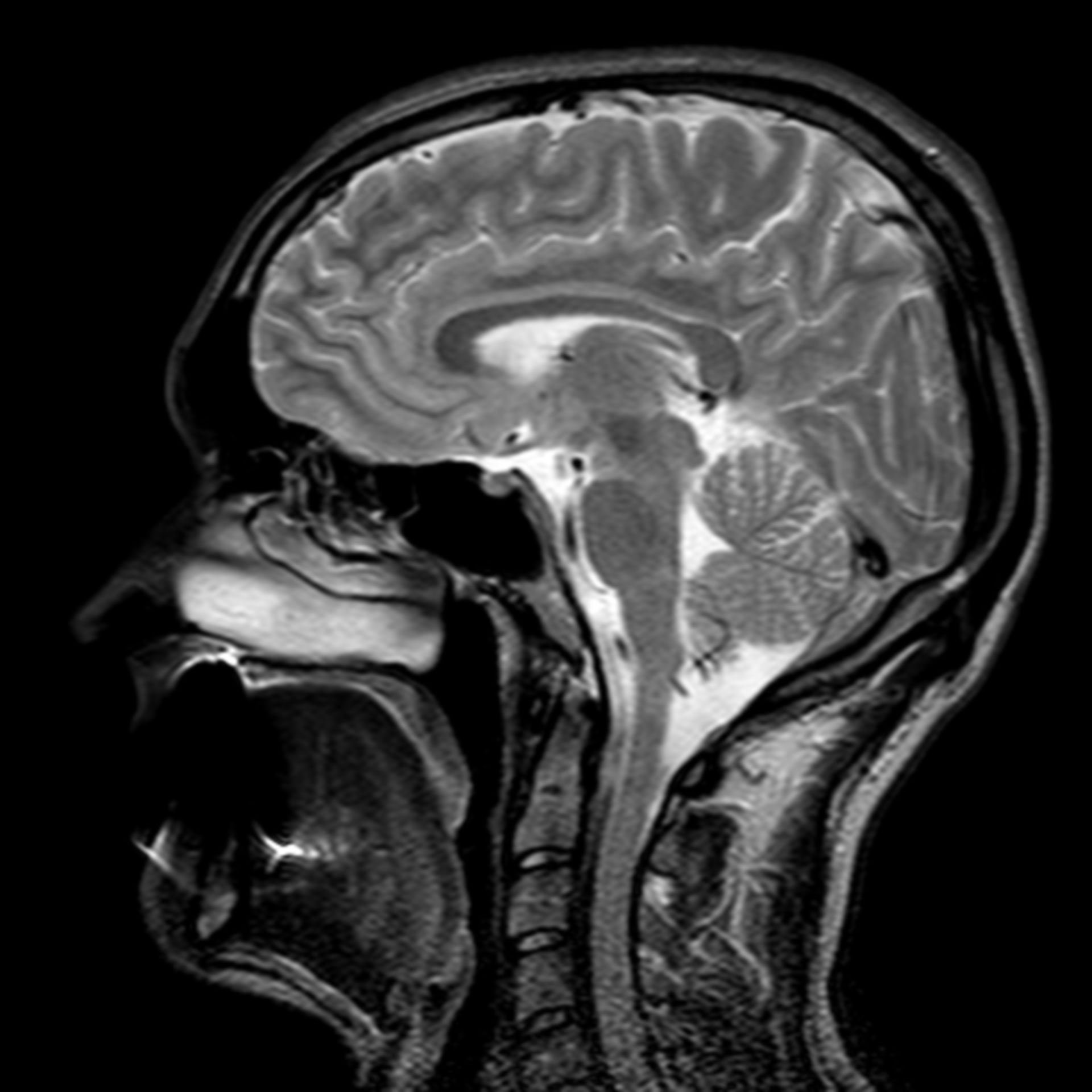 (18/34) MRT Schädel in Sagittalebene, T₂‐gewichtet