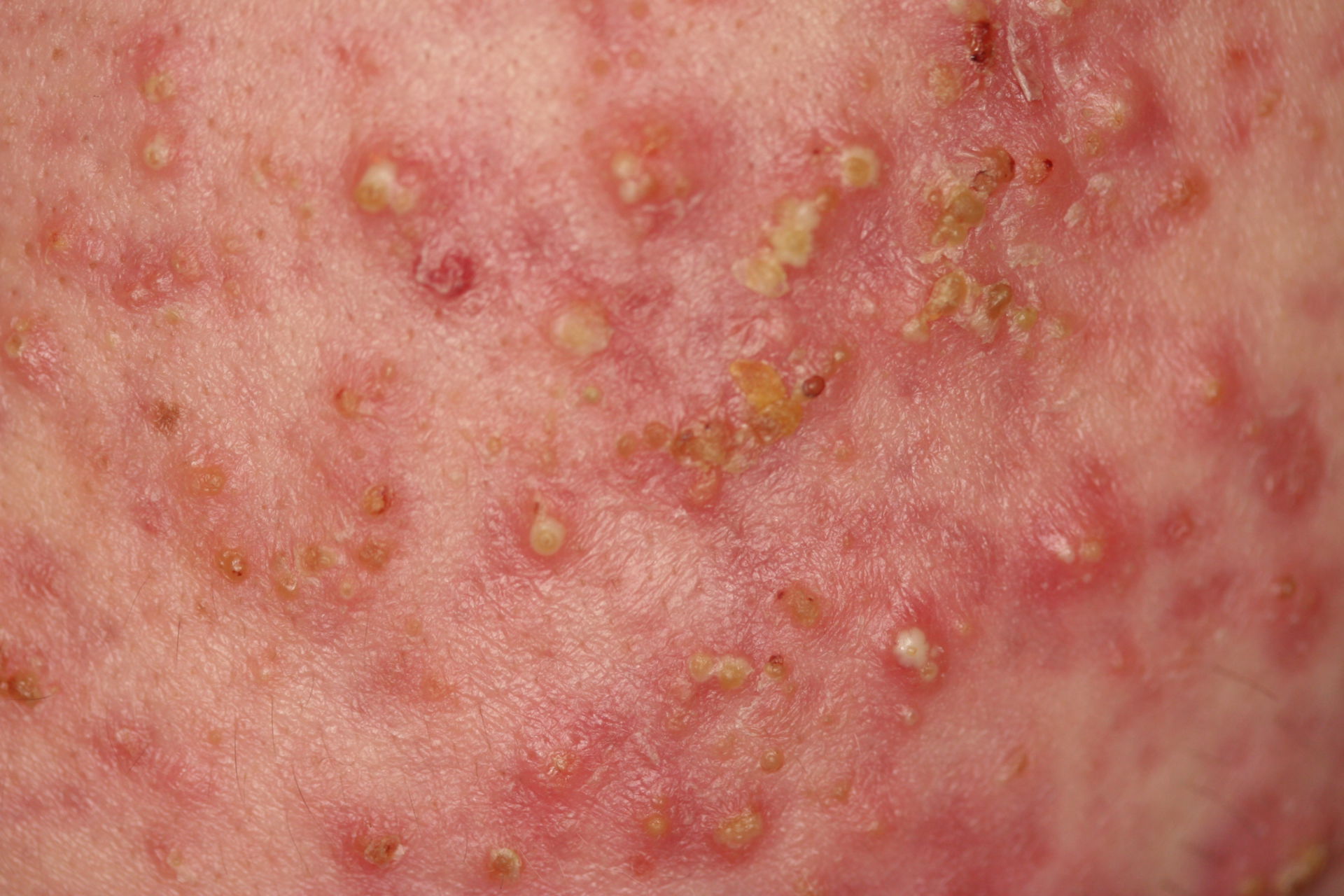 Papular and pustular acne, close up