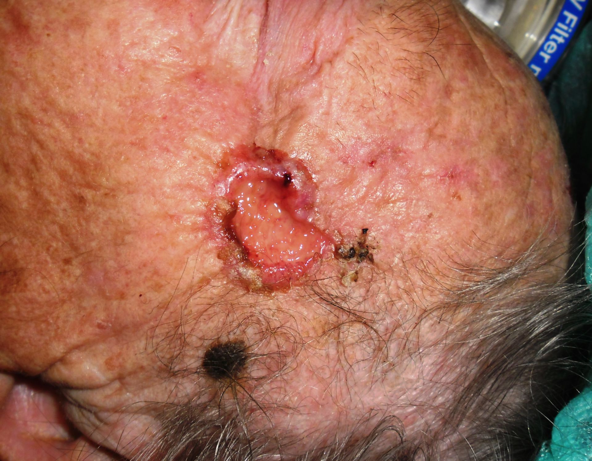 Haut Tumor temporal - Plattenepithelcarcinom