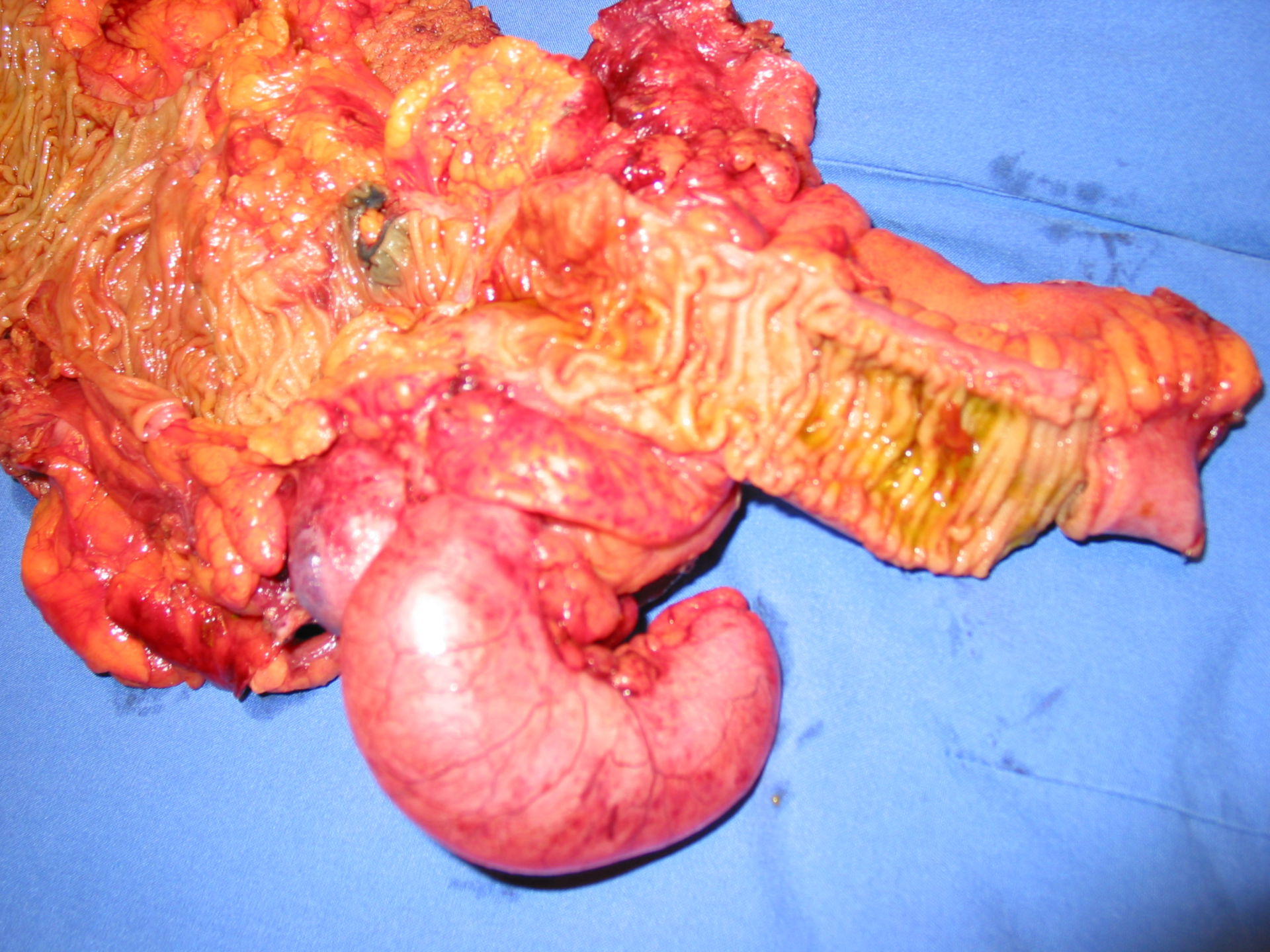 Mukozele der Appendix - Resektionspräparat