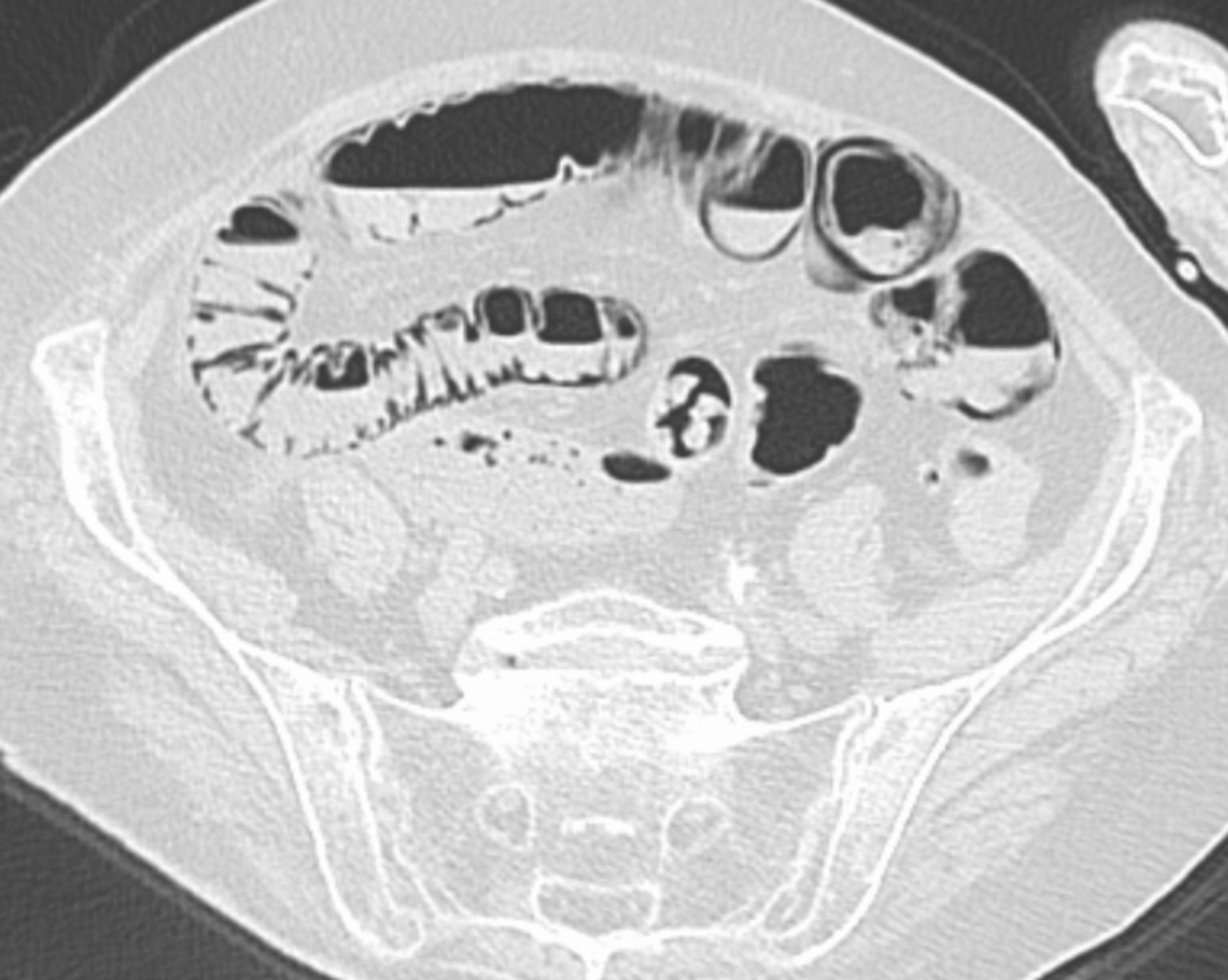 Pneumatosis intestinalis (CT)