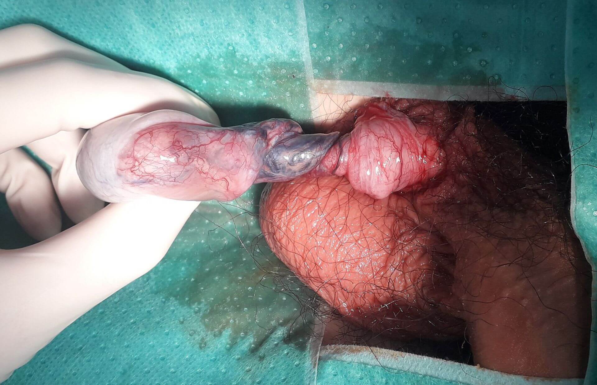 Hodentorsion