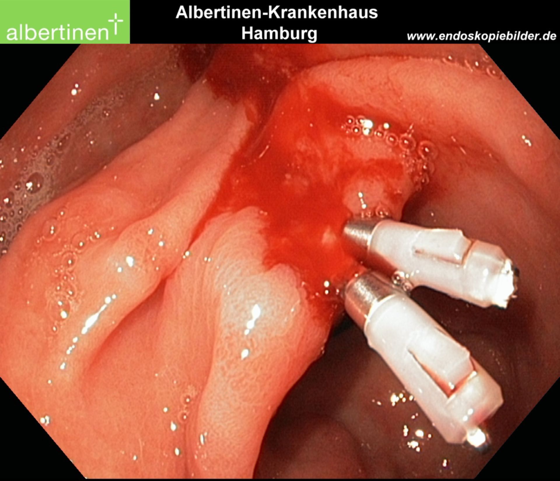 Ulcer-angulus-bleeding-clips (endoscopy) - DocCheck 