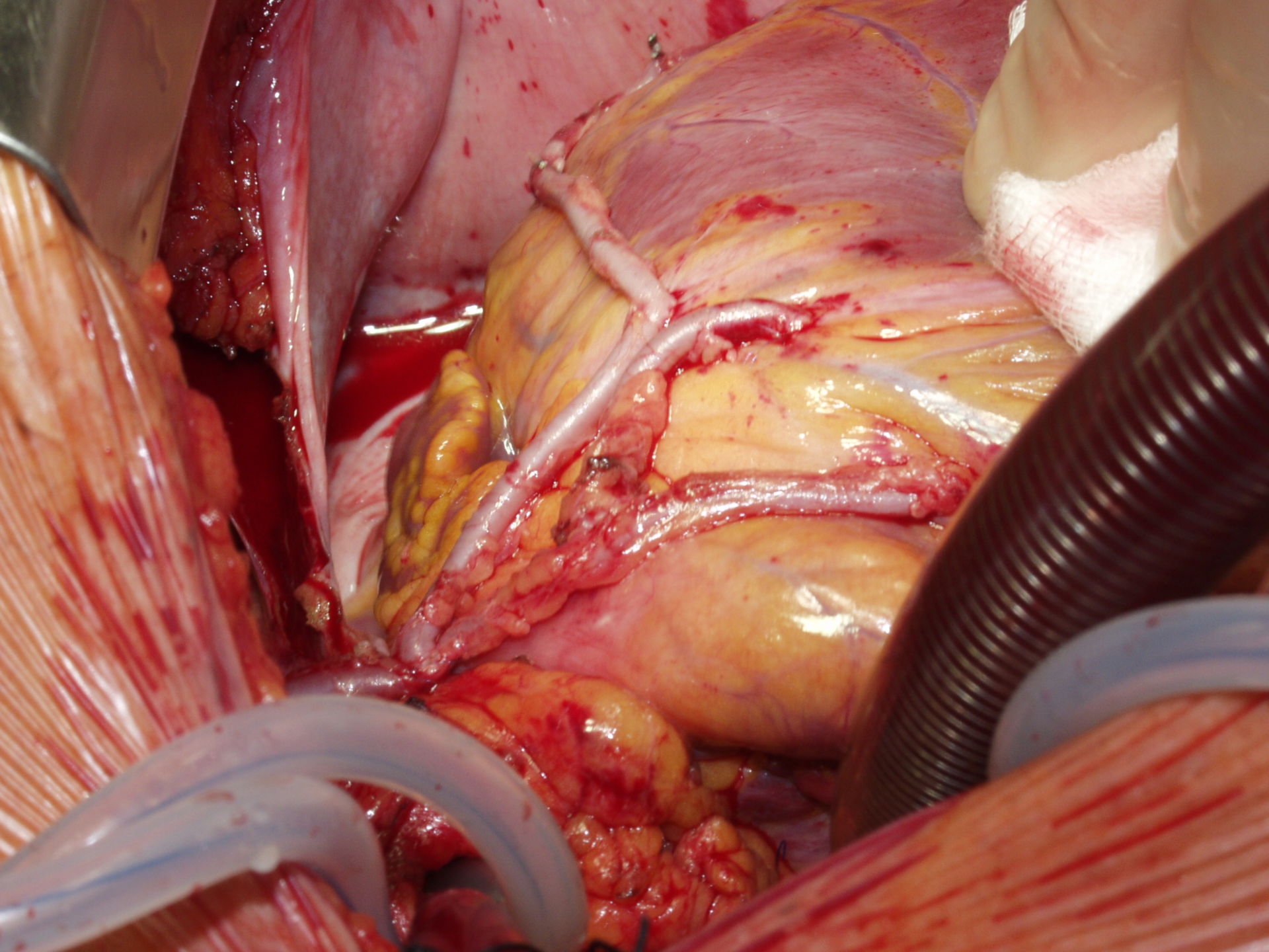 Coronary artery bypass - total revascularisation (B)