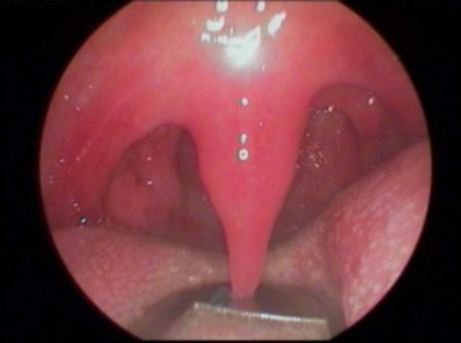 Long uvula