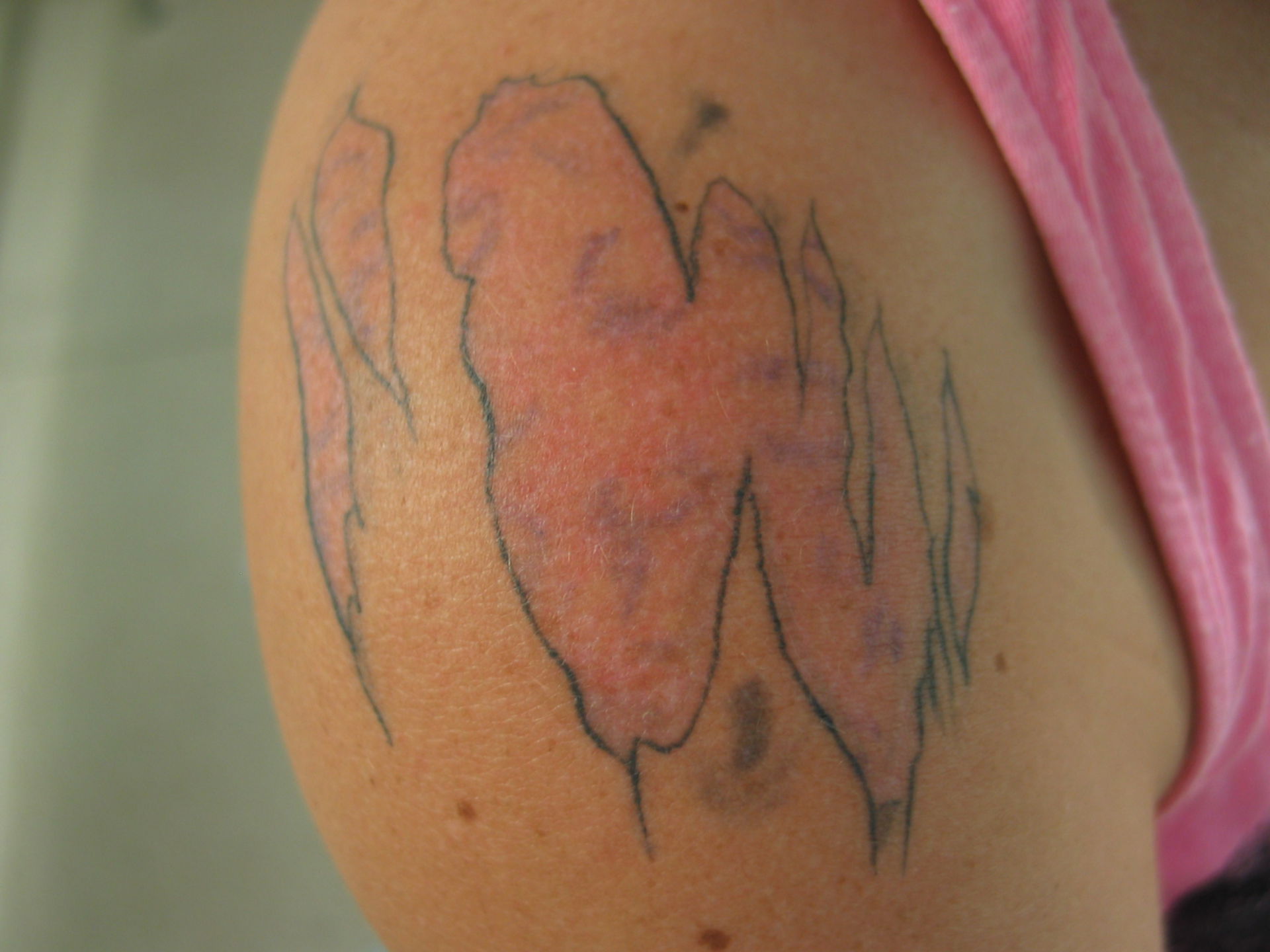 Allergic Contact Dermatitis in a tatoo