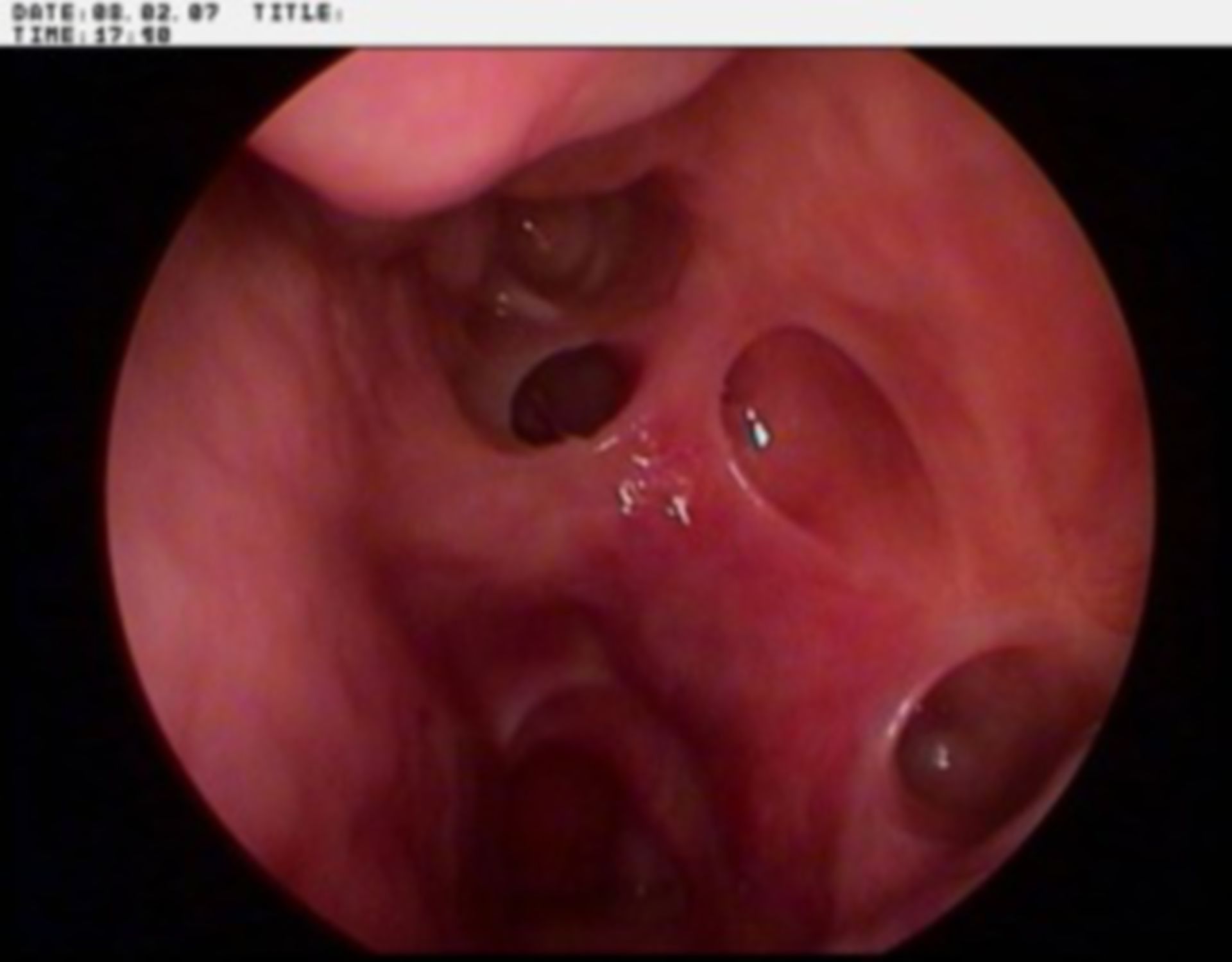 Condition after polyp operation