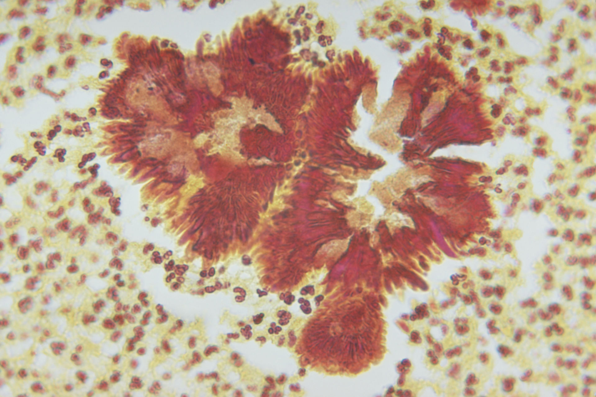 Botryomykose durch Pseudomonas aeruginosa (Brown-Brenn Färbung)