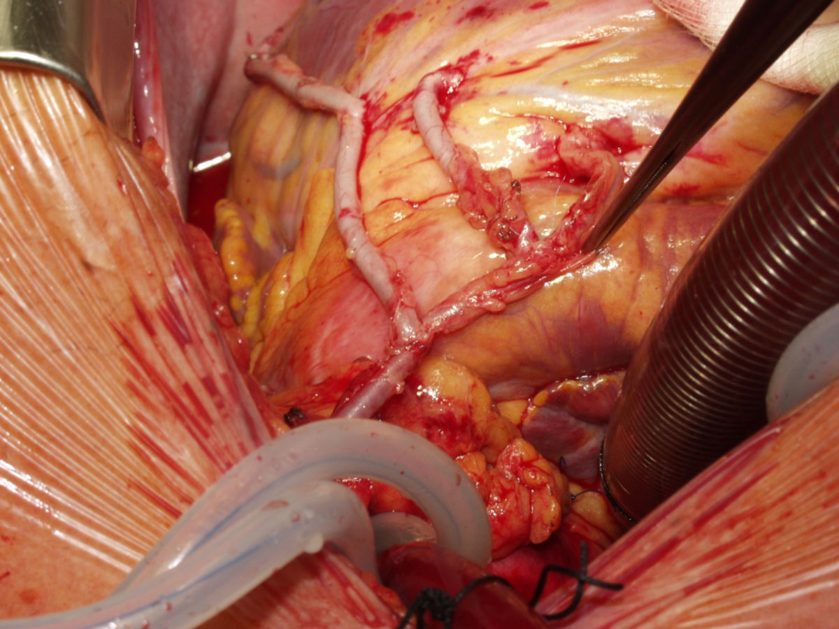 Bypass-OP mit totaler arterieller Revaskularisation (Abb. 2d)