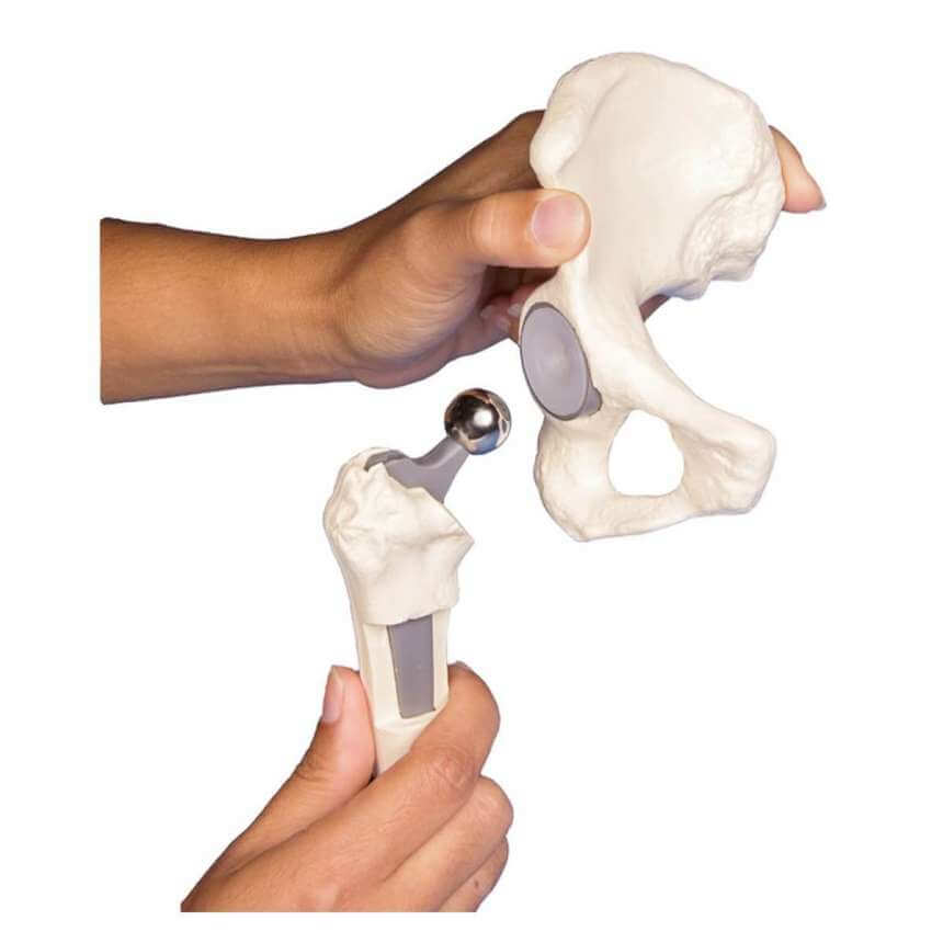 Erler-Zimmer Hip implant model | DocCheck Shop