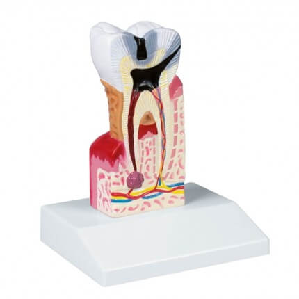 Model voor tandbederf