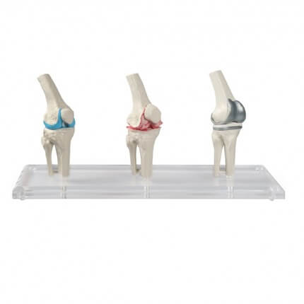 Model voor knie-implantaten