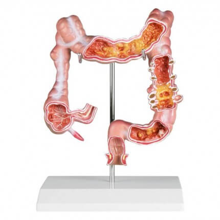 Colon model with diseases