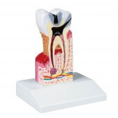Erler-Zimmer Modèle de carie dentaire